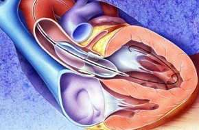 Structural Heart Intervention